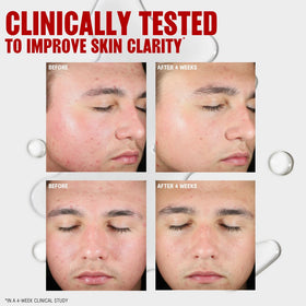 Thayers toner being applied to skin from hand, helps remove oil and impurities