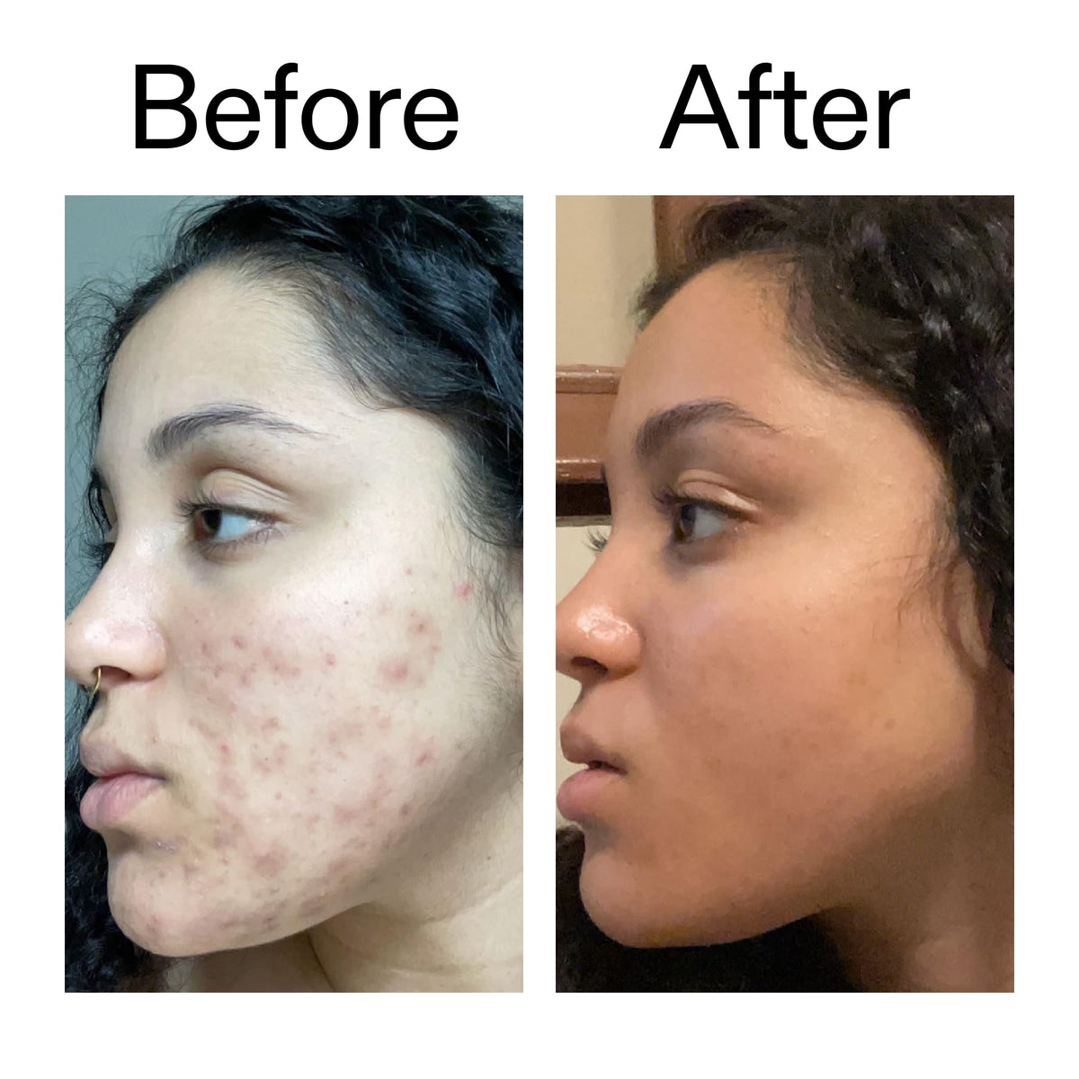 Before and after comparison demonstrating improved tone with The INKEY List treatment benefit