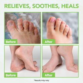 Thena applying cream between toes to relieve itch and moisture