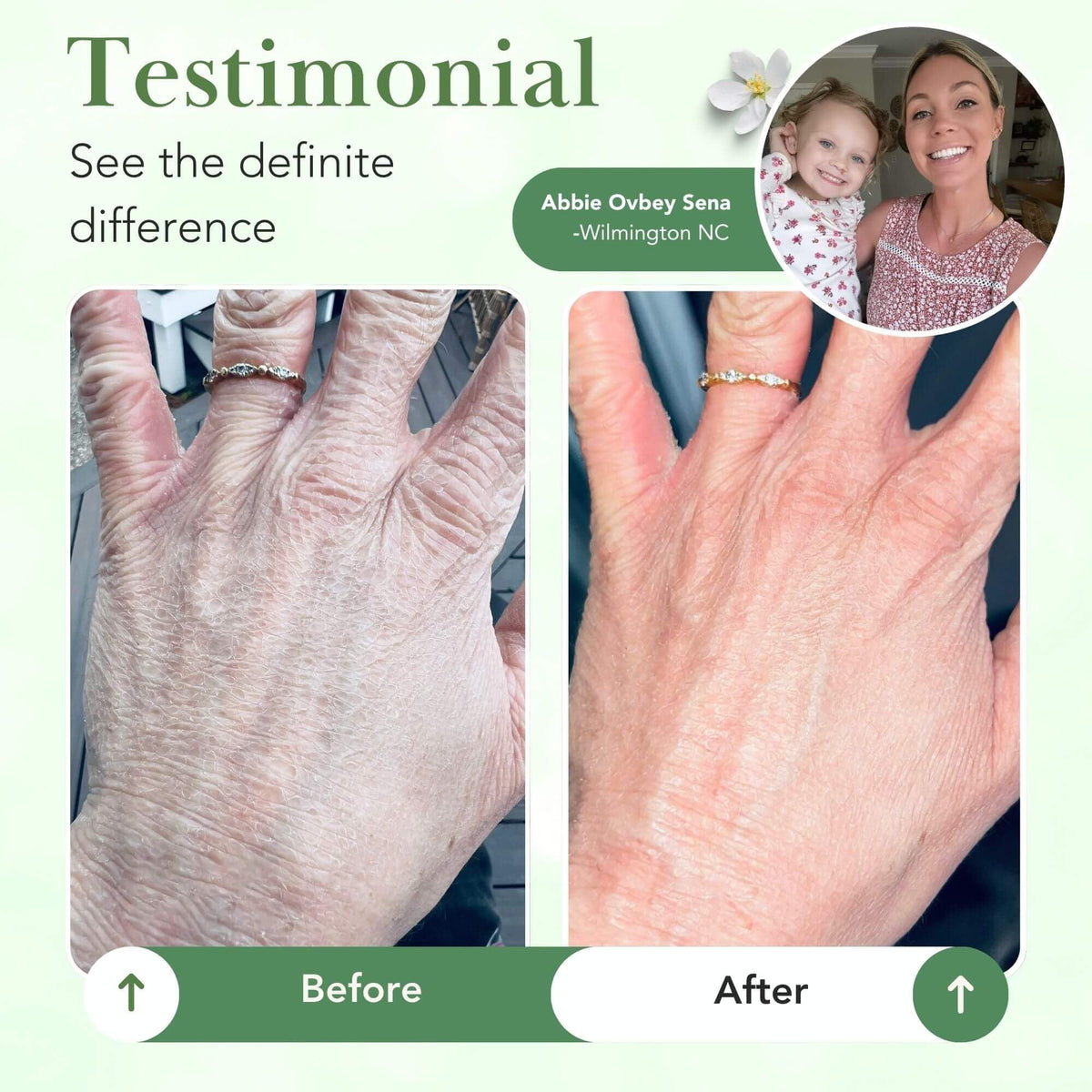 Theraplex applied to hand demonstrating fast absorption and immediate soothing benefit