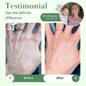 Theraplex applied to hand demonstrating fast absorption and immediate soothing benefit