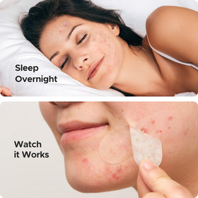 TKTK 8mm-10mm-12mm dot patches array for precise spot treatment
