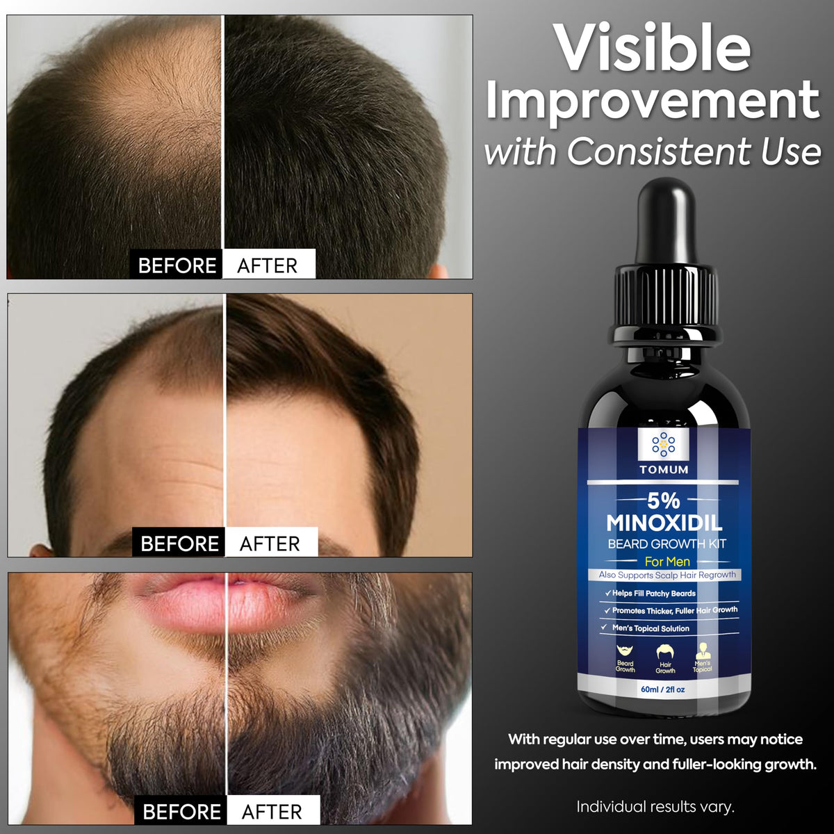 TOMUM application on beard demonstrating targeted coverage for patchy areas