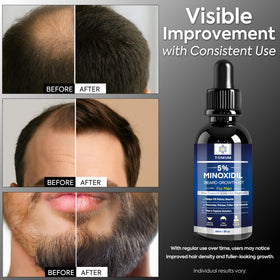 TOMUM application on beard demonstrating targeted coverage for patchy areas