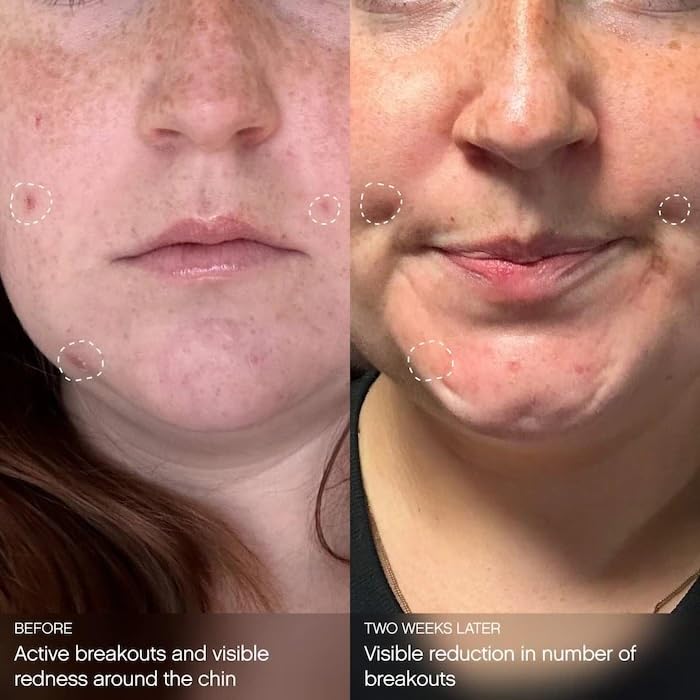 Topicals mask applied to cheek demonstrating soothing and clarifying action