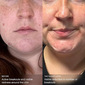 Topicals mask applied to cheek demonstrating soothing and clarifying action