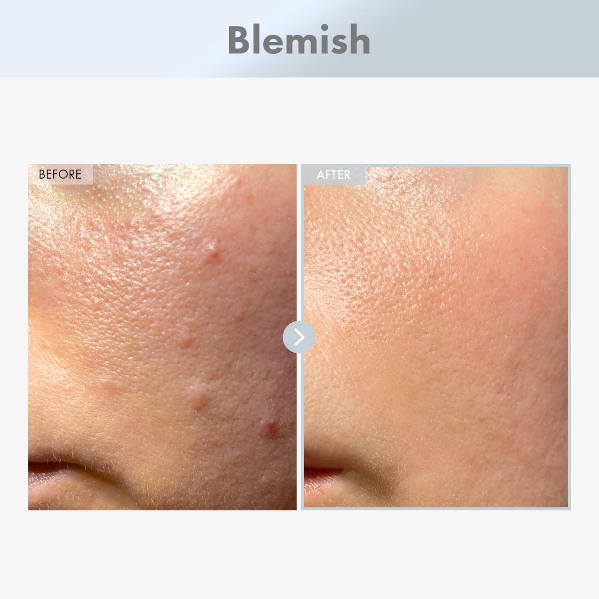 TOSOWOONG dropper dispensing clear serum, illustrating precise dosage benefit