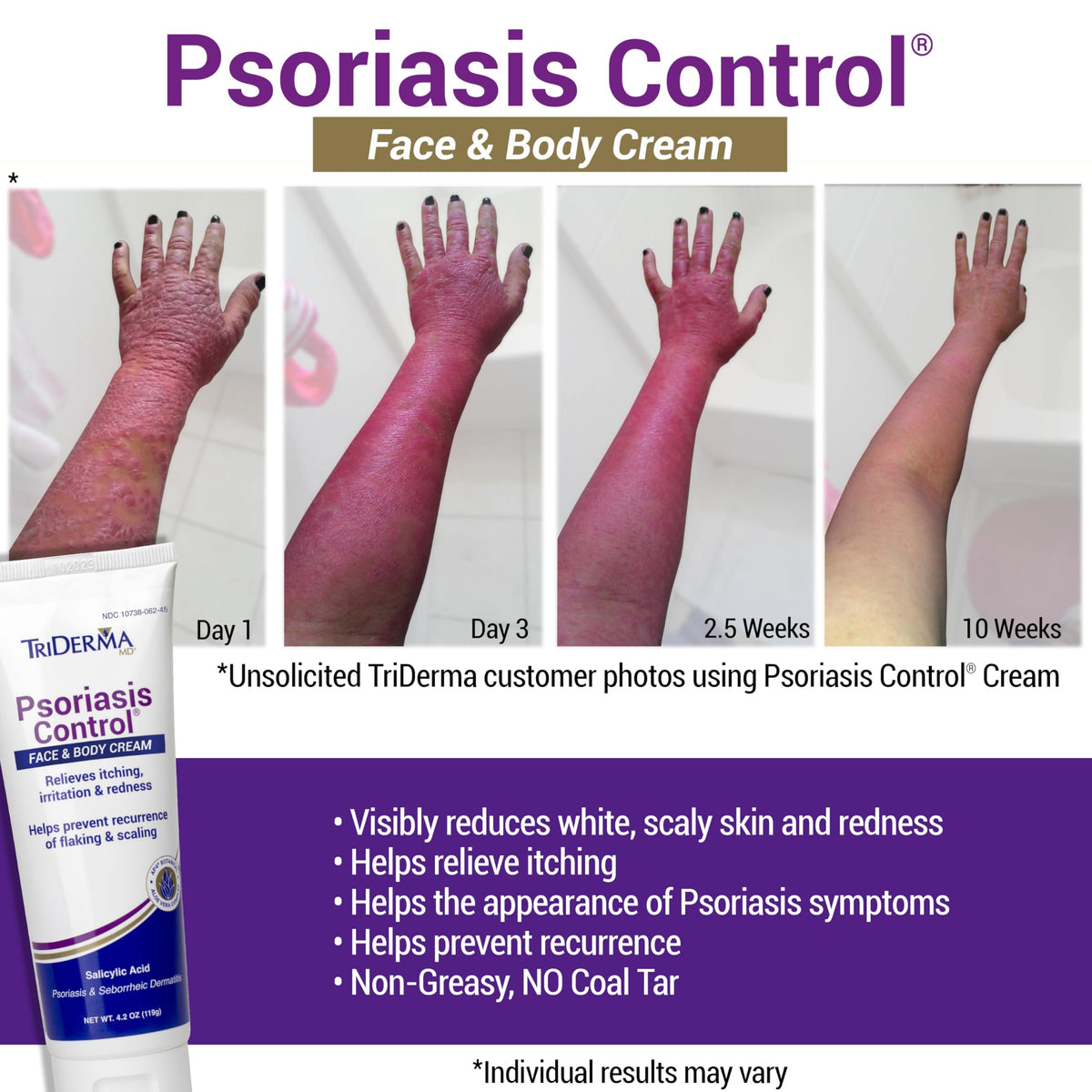 TriDerma cream texture on hand illustrating non-greasy feel and quick absorption benefit