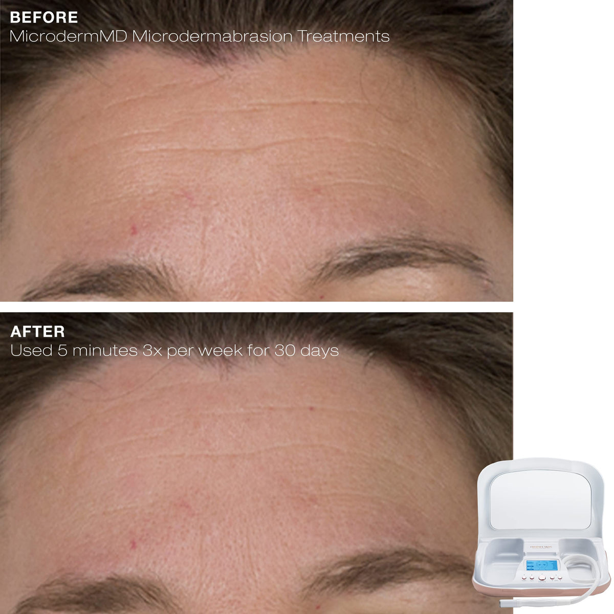 Trophy Skin MicrodermMD being used on cheek to demonstrate gentle exfoliation and smoother skin