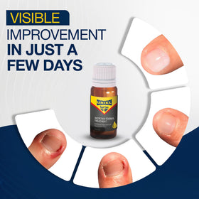 URIEL dropper close-up applying drops to nail edge for precise targeting