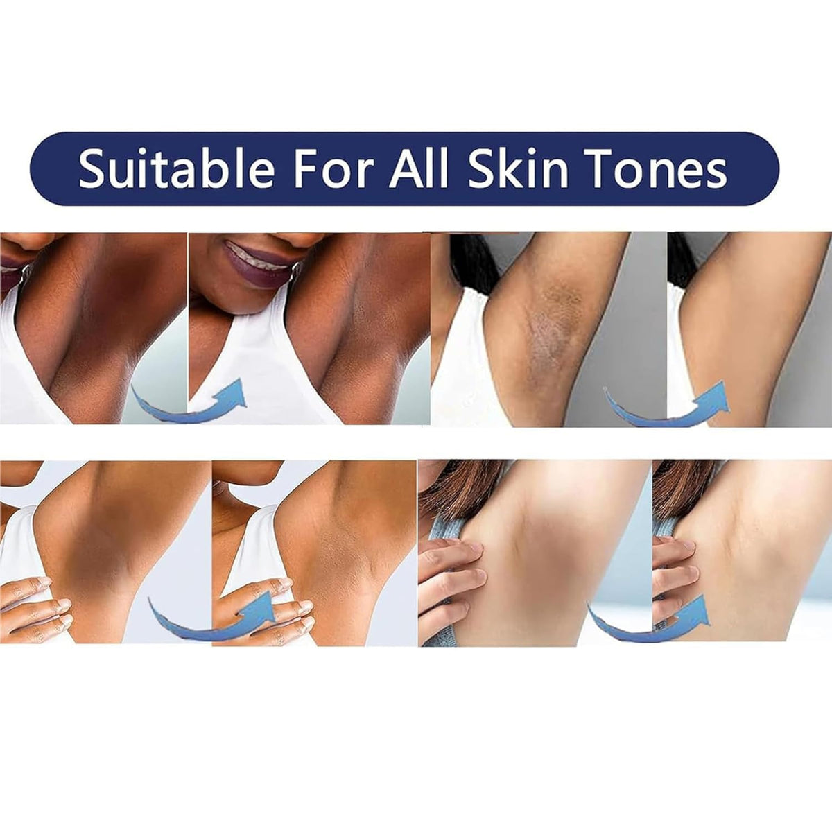 Vcetree applied to inner thigh to show targeted use and even coverage benefit