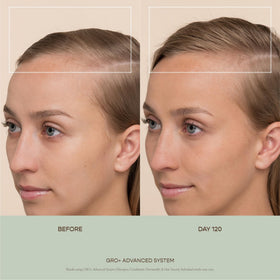 VEGAMOUR GRO+ close-up of 1,200 stainless steel needles highlighting gentle exfoliation