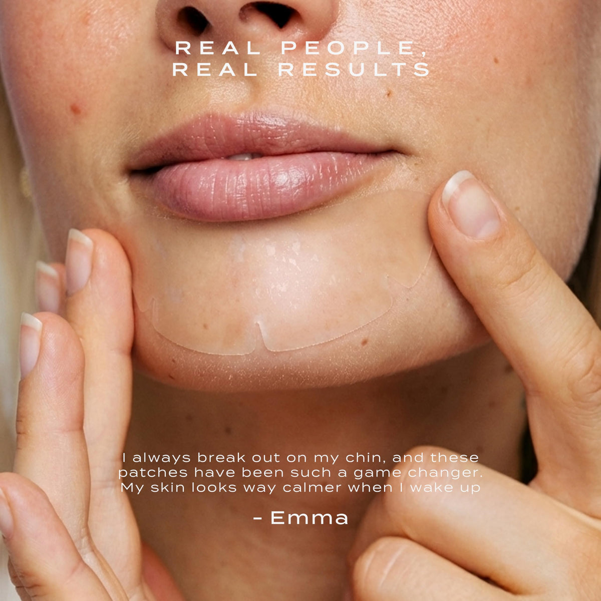 Vue patch applied on a chin demonstrating secure overnight adhesion benefit