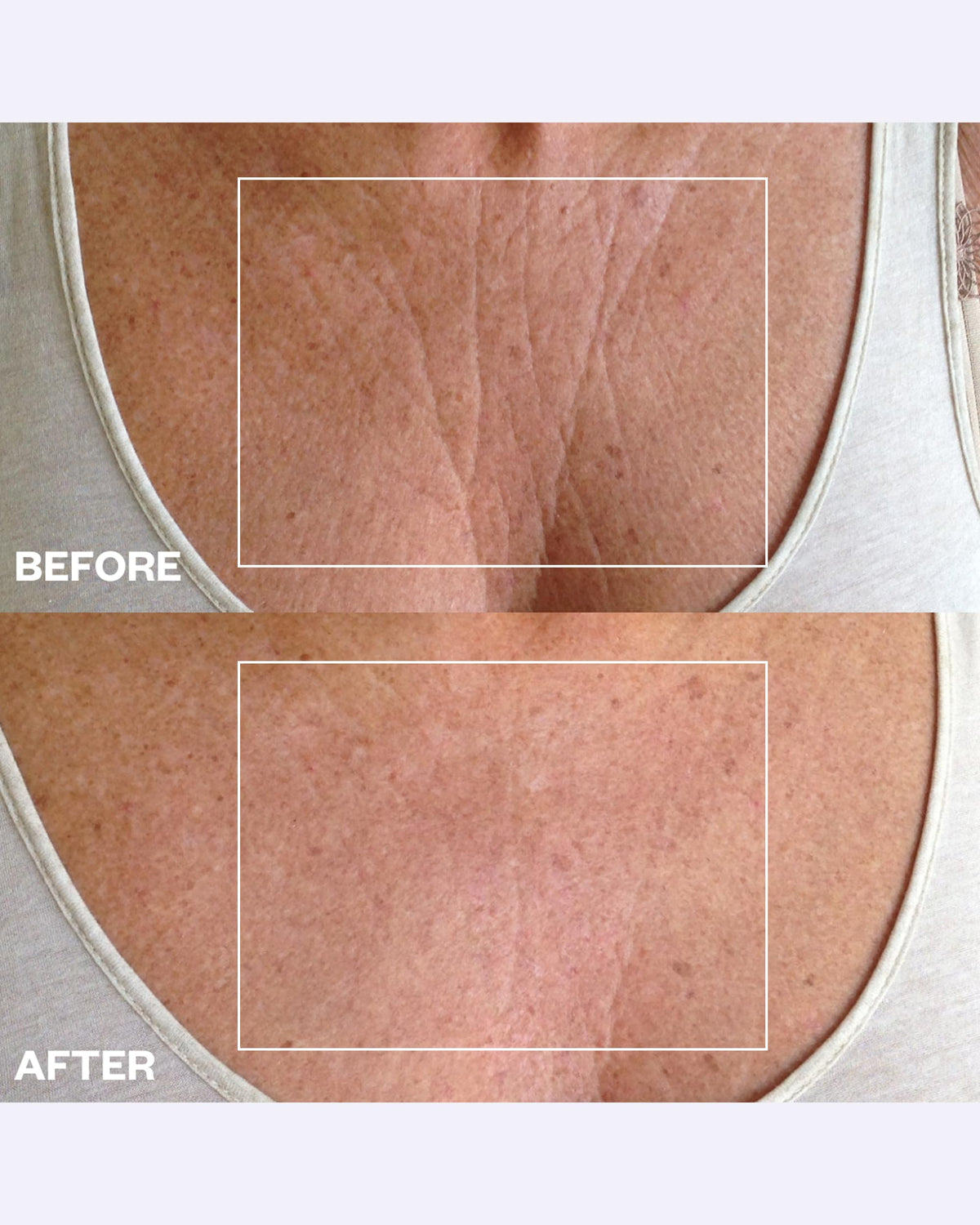 Wrinkles Schminkles applied on chest demonstrating smoothing effect