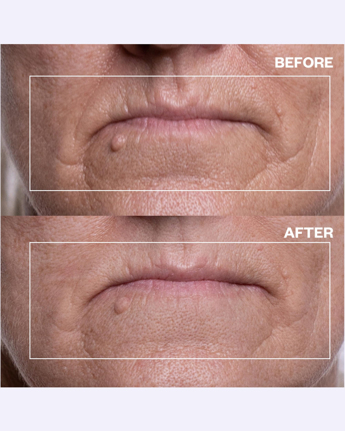 Wrinkles Schminkles patch on lips while sleeping for overnight wrinkle prevention