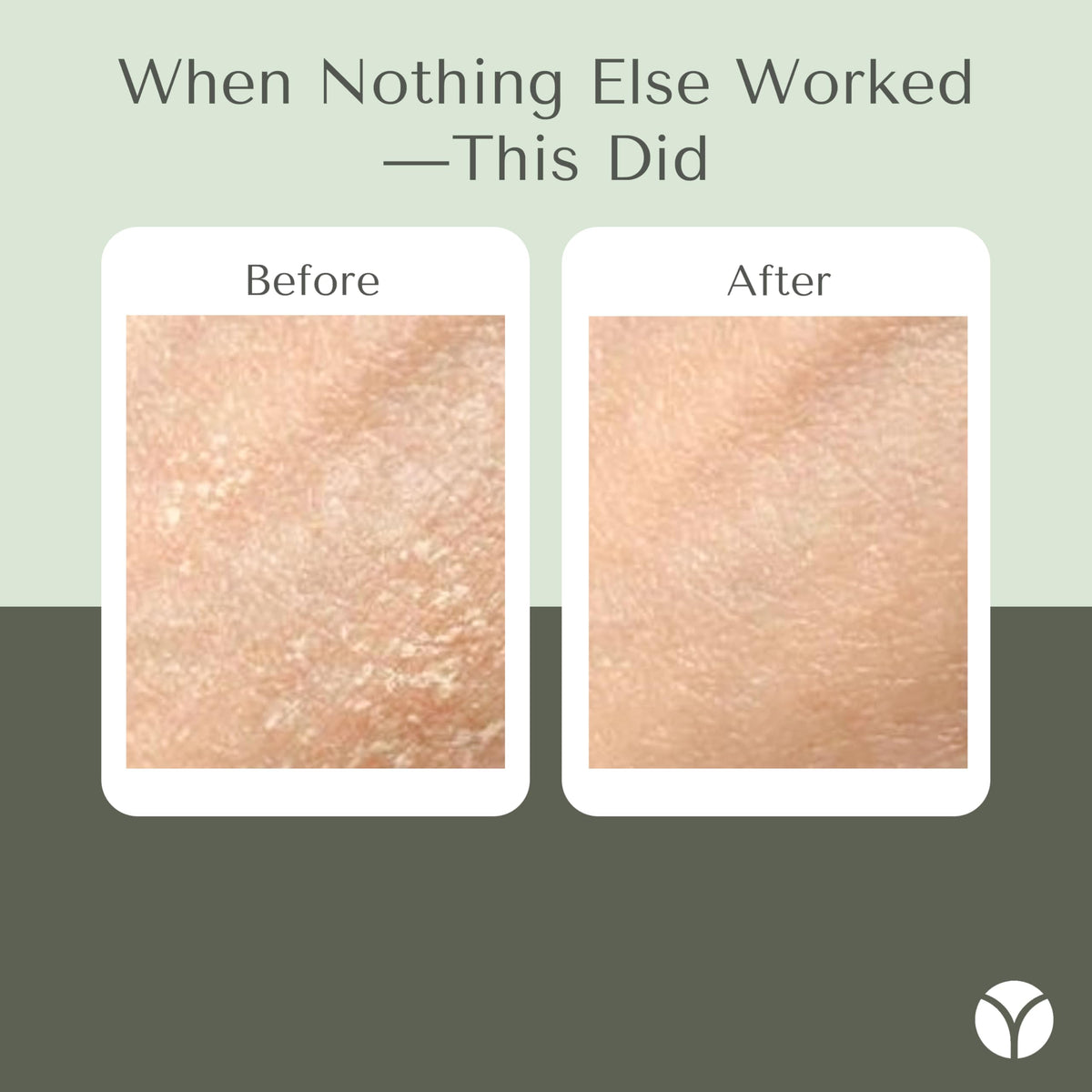 Yobee tube dispensing cream onto fingertip for precise application benefit