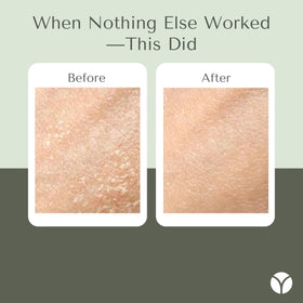 Yobee tube dispensing cream onto fingertip for precise application benefit