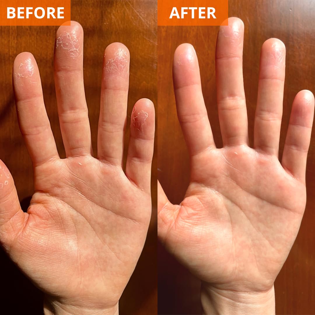 Yu-Be on hands and feet showing softened skin and visible smoothing
