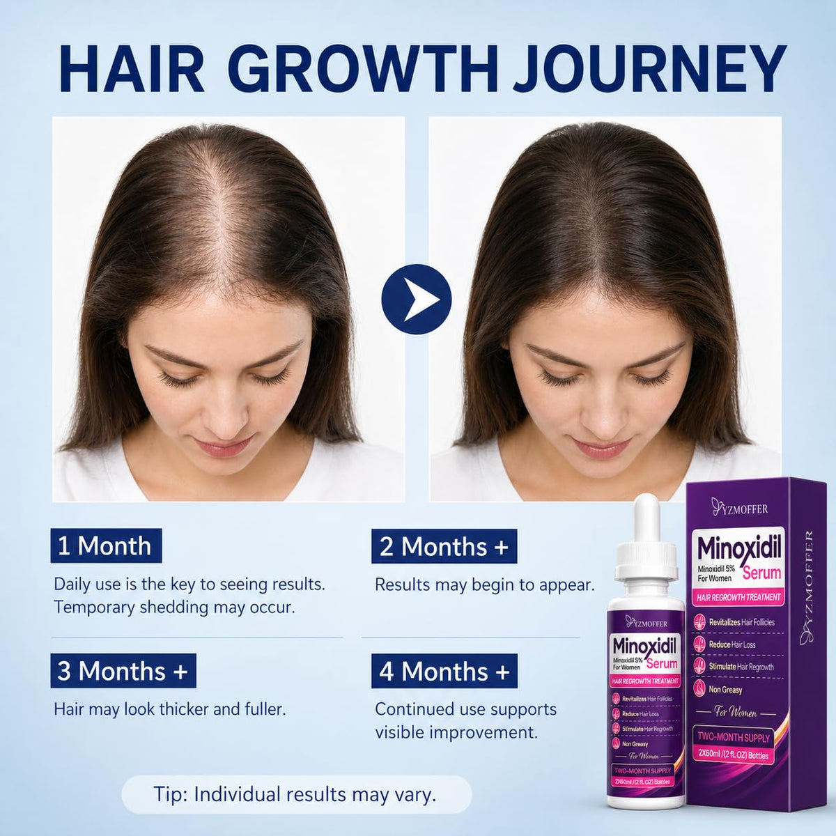 Yzmoffer being applied to scalp to target thinning areas and reduce shedding