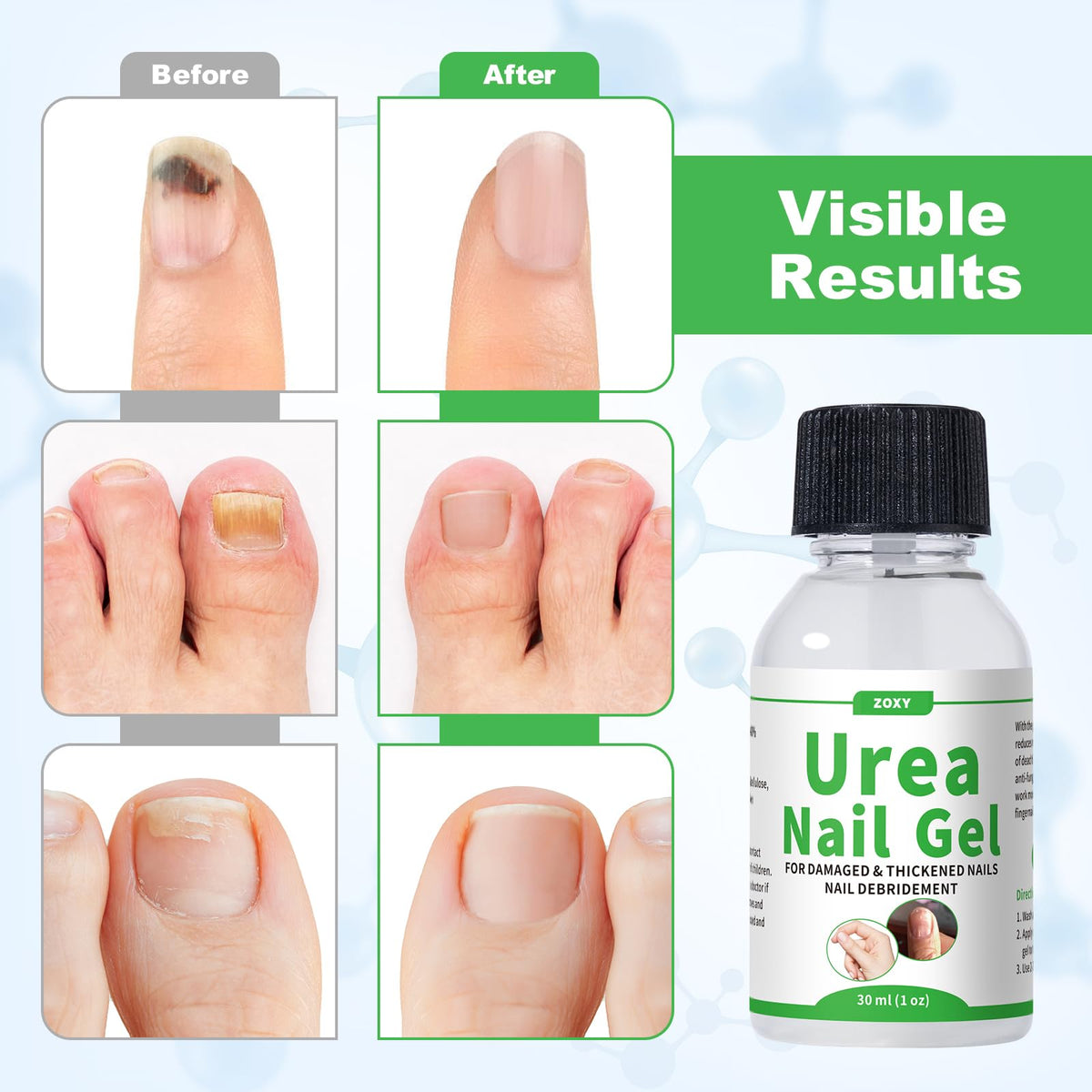 ZOXY applied to toenail demonstrating targeted softening and improved texture