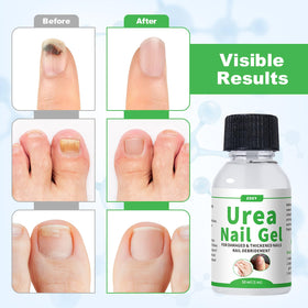 ZOXY applied to toenail demonstrating targeted softening and improved texture
